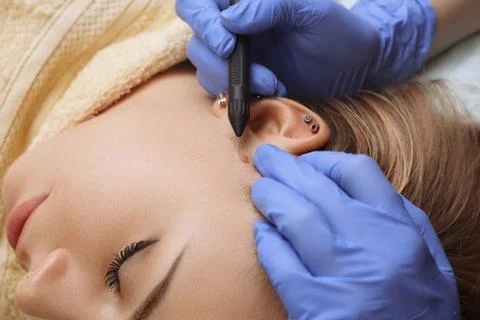 Electrocoagulation of vessels on the face Stock Photos