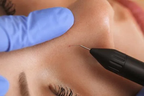 Electrocoagulation of vessels on the face Stock Photos