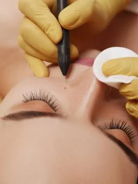 Electrocoagulation of vessels on the face Stock Photos