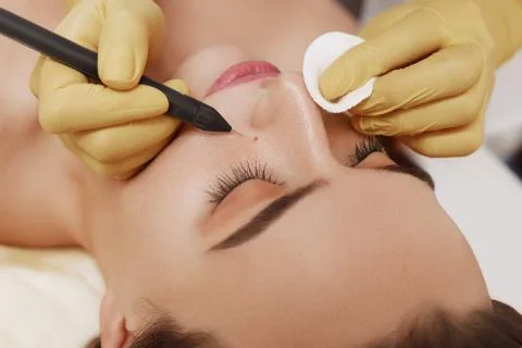 Electrocoagulation of vessels on the face Stock Photos