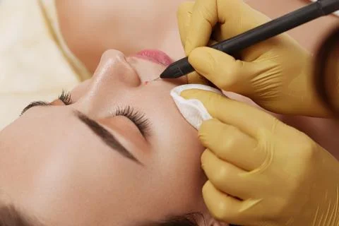 Electrocoagulation of vessels on the face Stock Photos