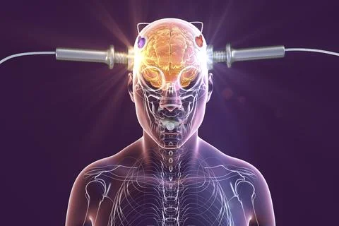 Electroconvulsive therapy, ECT, a treatment involving the use of electrical.. Illustrazione stock