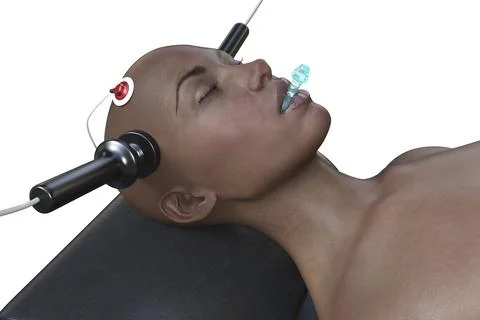 Electroconvulsive therapy, ECT, a treatment used for severe mental illnesses  Stock Illustration