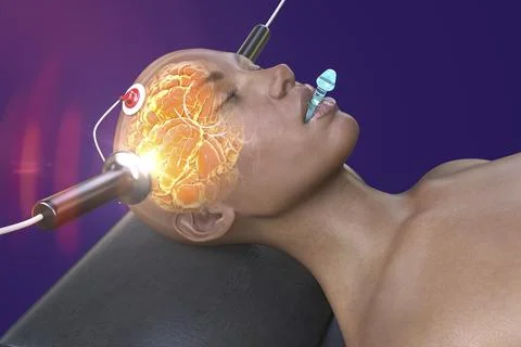 Electroconvulsive therapy, ECT, a treatment used for severe mental illnesses  Illustrazione stock