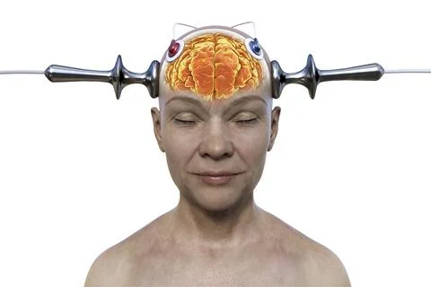 Electroconvulsive therapy, ECT, a treatment used for severe mental illnesses  Illustrazione stock