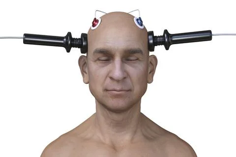 Electroconvulsive therapy, ECT, a treatment used for severe mental illnesses  Stock Illustration