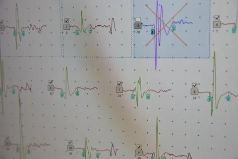Electroencephalogram eeg brain wave analysis on screen. Stock Photos