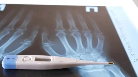 An electronic thermometer lies on the x-ray of the hands. Close-up Stock Footage 73827590