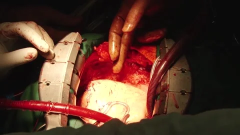 Electroshock heart surgery Stock Footage 130377284