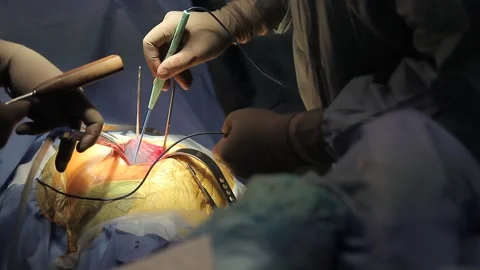 Electrosurgery Close-up Stock Footage 288811430