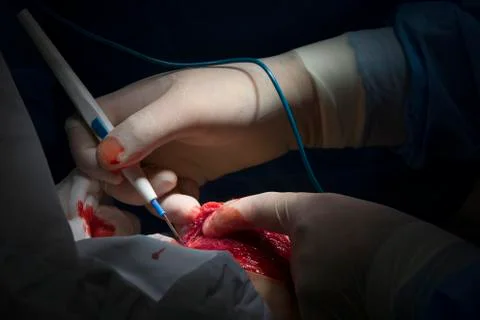 Electrosurgery close-up Photos