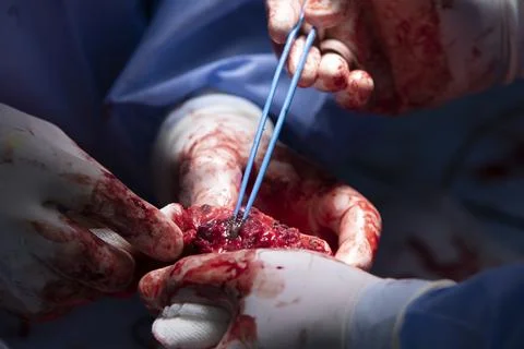 Electrosurgical Forceps At Surgery Stockfoto's