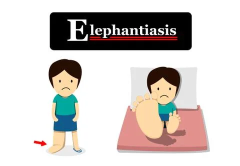 Elephantiasis in flat cartoon, vector Stock Illustration