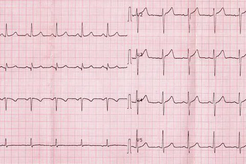 Elettocradiogram Stock Photos