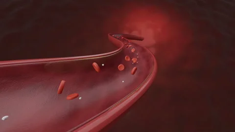 Embolic stroke and cholesterol 스톡 동영상 251925751