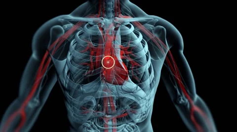 Embolus (clot) moving to brain Stockbeeldmateriaal 50420928