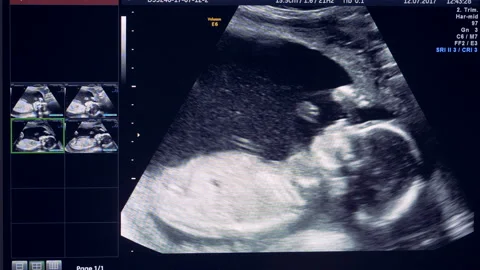 Embryo is actively moving an rolling over on an ultrasound image Stock-Footage 88207355