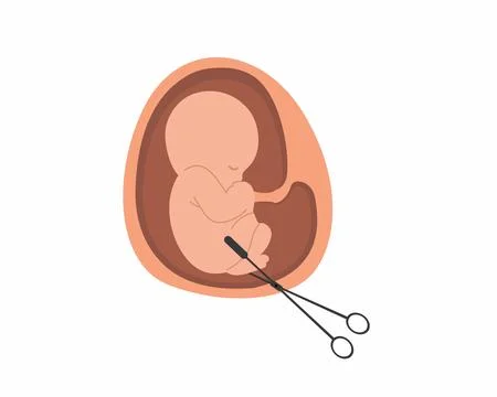 Embryo with surgical forceps stop abortion campaign Infertility miscarriage Stock Illustration