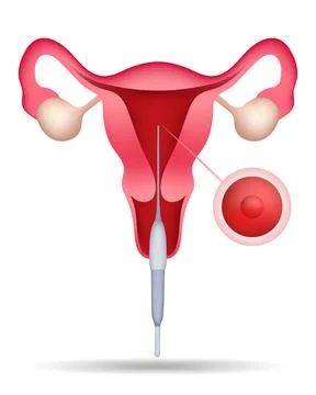 Embryo transfer procedure used during IVF fertility treatment Stock Illustration