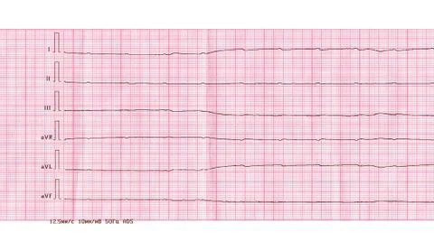 Emergency cardiology and resuscitation. ECG with ventricular asystole Stock Photos
