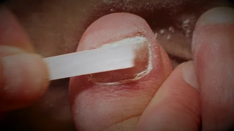 Emery boards filing down a big toe nail with fungal infections Video stock 291072653