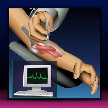 EMG Testing Stock Illustration