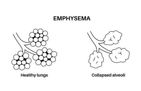 Emphysema anatomical poster Stock Illustration