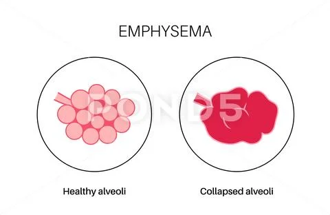 Emphysema anatomical poster: Royalty Free #236884058