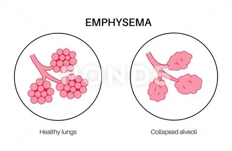 Emphysema anatomical poster: Royalty Free #237055698