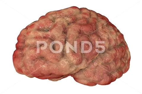 Encephalitis concept, illustration showing edema and hemorrhages in brain Stock Illustration