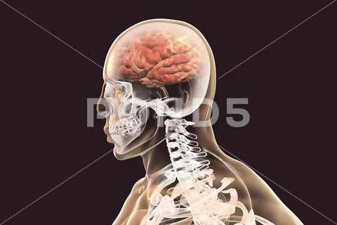 Encephalitis concept, illustration showing edema and hemorrhages in brain Stock Illustration