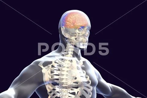 Encephalitis concept, illustration showing edema and hemorrhages in brain Stock Illustration