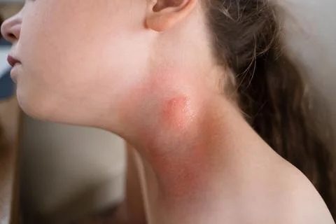 Encephalitis Mite Bug Or Arachnid Parasite Stock Photos