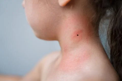 Encephalitis Mite Bug Or Arachnid Parasite Foto stock
