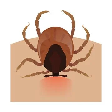 Encephalitis tick biting human skin causing lyme disease Stock Illustration