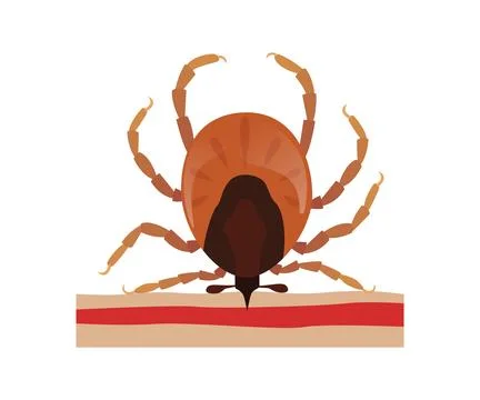 Encephalitis tick biting human skin, mite Illustrazione stock