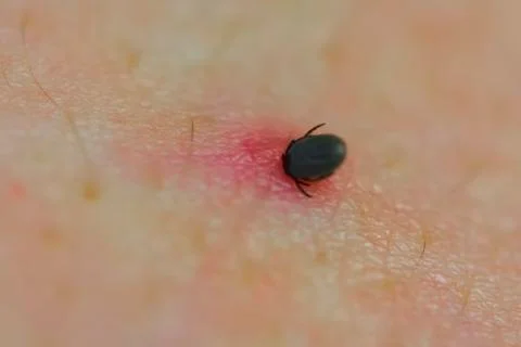 Encephalitis tick, tick bite at spring Stock Photos