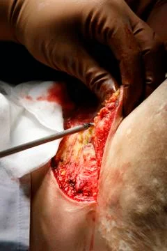 Endo-surgery close-up 写真素材