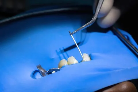 Endodontic file inserted into root canal under rubber dam Stockfoto's