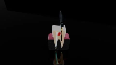 Endodontic file treating root canal in molar tooth cross section, 4K Stock Footage 346121143