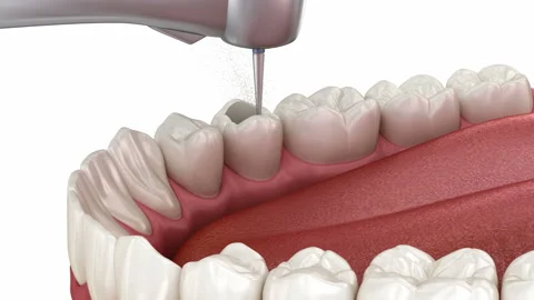 Endodontic root canal treatment process Video stock 144660364