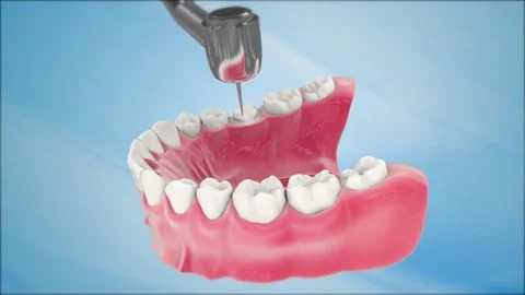 Endodontic root canal treatment process. Medically accurate tooth 3D animatio Stock Footage 220621030