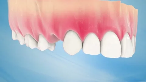 Endodontic root canal treatment process. Medically accurate tooth 3D animatio Stock Footage 220621047
