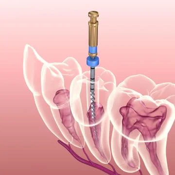 Endodontic root canal treatment process. Medically accurate tooth 3D illustra Stock Illustration