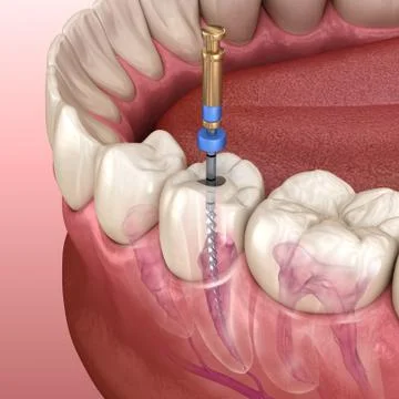 Endodontic root canal treatment process. Medically accurate tooth 3D illustra Stock Illustration
