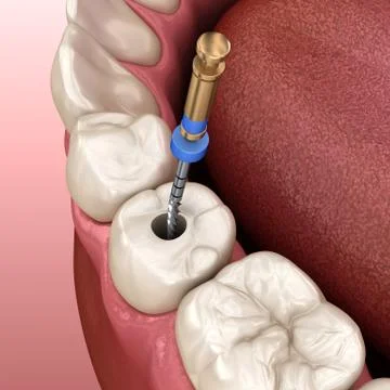 Root canal treatment process. 3D illustration