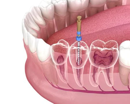 Endodontic root canal treatment process. Medically accurate tooth 3D illustra Illustrazione stock