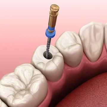 Endodontic root canal treatment process. Medically accurate tooth 3D illustra Stock Illustration