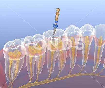 Endodontic root canal treatment process. Medically accurate: Graphic ...