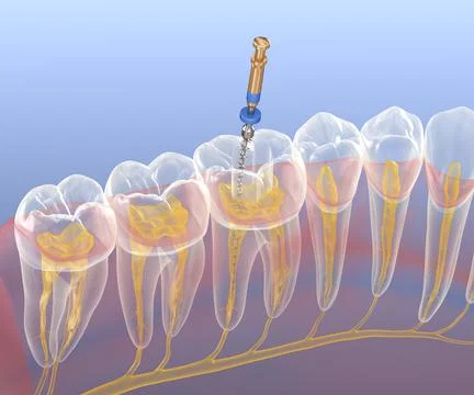 Endodontic root canal treatment process. Medically accurate tooth 3D  illustration. Stock Illustration